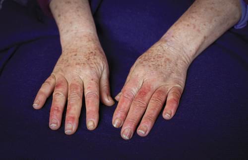 Scleroderma on hands